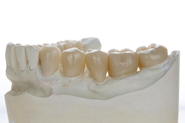 A woman showing her teeth in a smile, with hidden lingual braces not visible in the image.