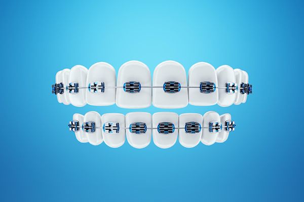 Orthodontic braces on a blue background, symbolizing brace treatment available in Westminster, London.