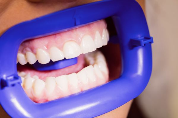 persons mouth with a blue dental mouth spreader, showing their teeth