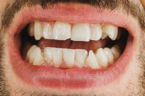 persons mouth showing crooked teeth