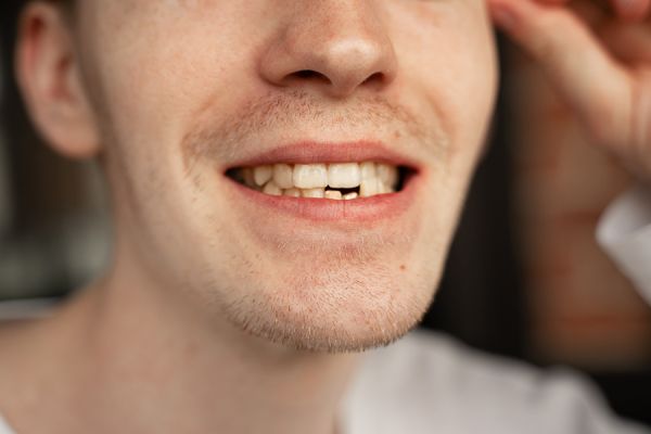 man with mishapened bottom teeth